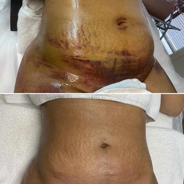 Post-Op Recovery- 5 Sessions at THAE Beauty Studio in Houston, TX
