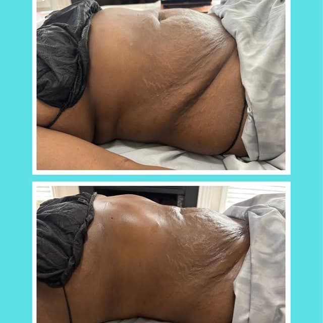 Post-Op Recovery- 3 Sessions at THAE Beauty Studio in Houston, TX