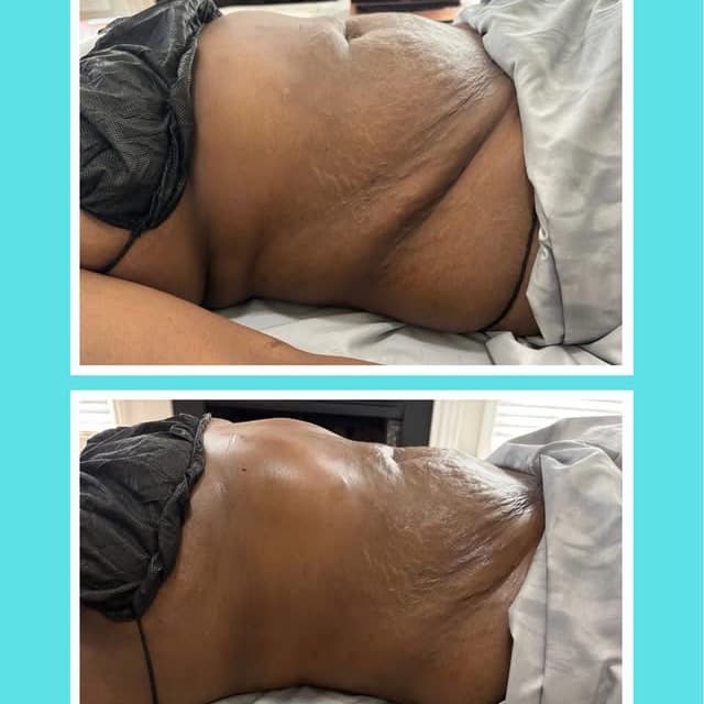 Post-Op Recovery- 10 Sessions at THAE Beauty Studio in Houston, TX